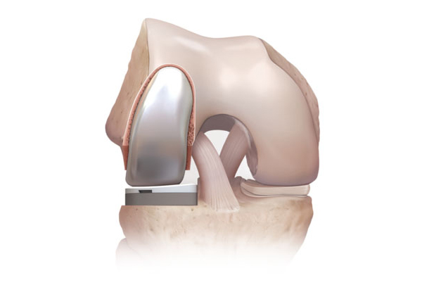 Partial Knee Replacement