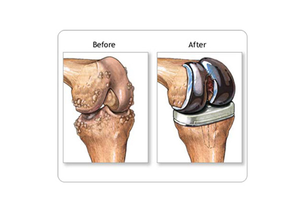 Total Knee Replacement