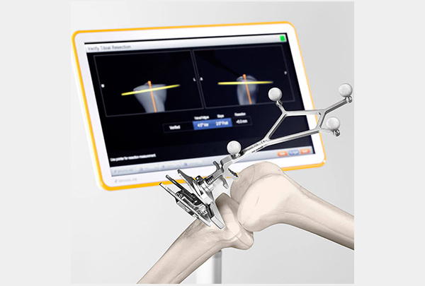 CAS (Navigation Joint Surgeries)