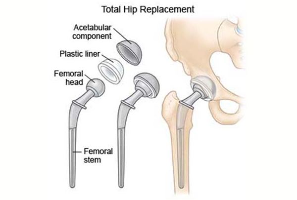 Total Hip Replacement