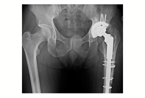 Revision Hip Replacement