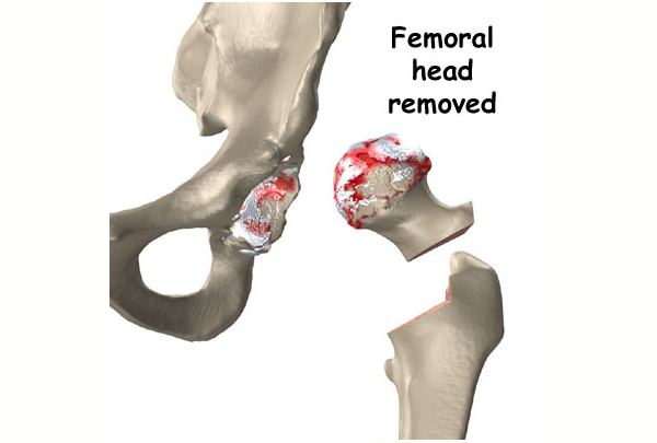 Hip Surgeries