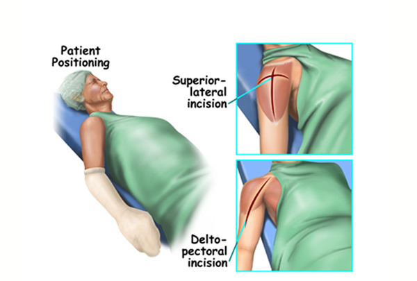 Reverse Shoulder Replacement