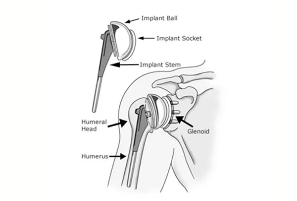 Hemi Shoulder Replacement