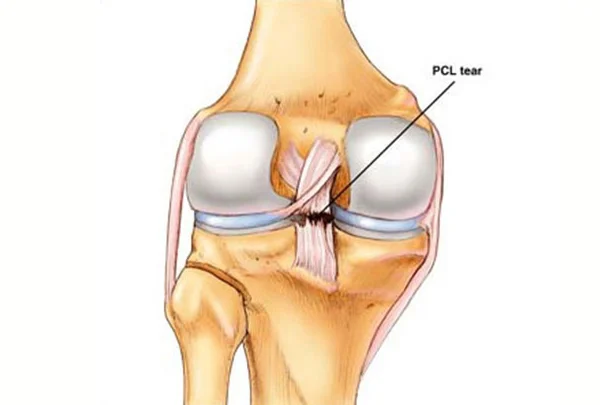 PCL Reconstruction