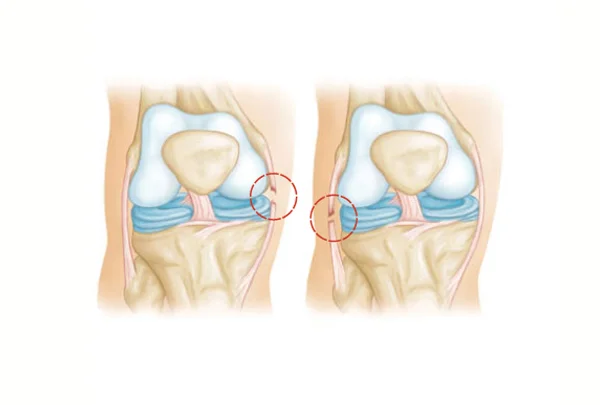LCL & MCL Reconstruction