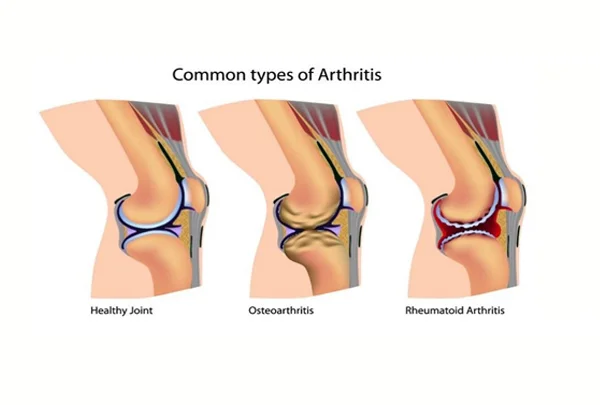 Advanced Arthritis