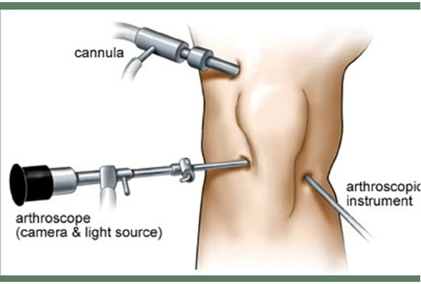 Arthroscopy